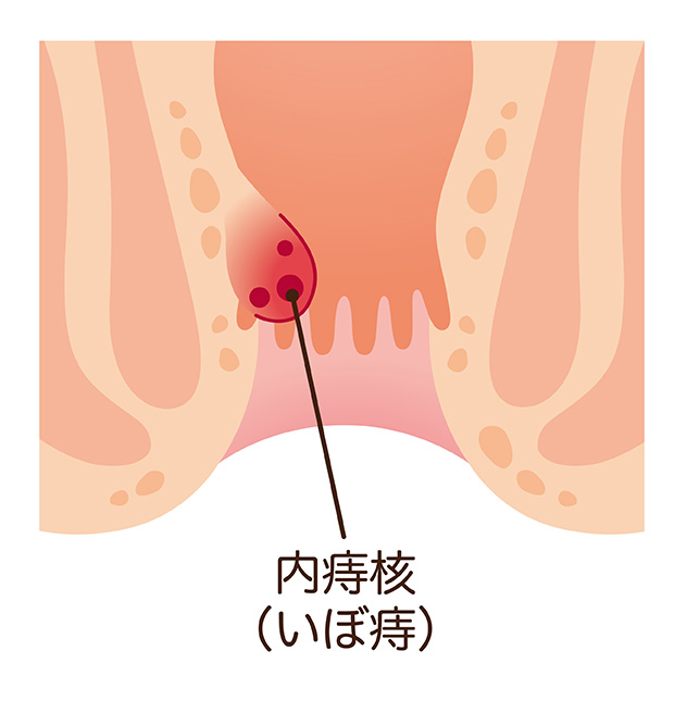 内痔核（いぼ痔）