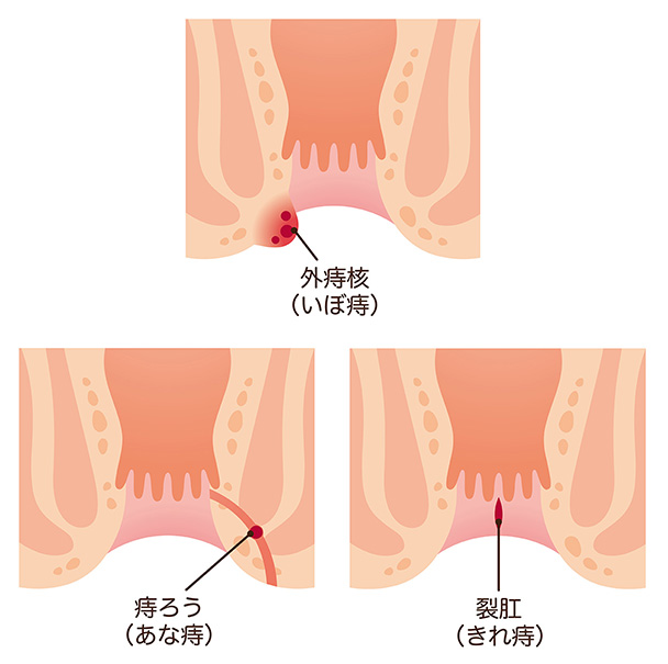 外痔核・痔ろう（あな痔）・裂肛（切れ痔）